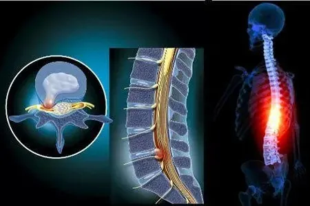 腰椎医疗最早情况